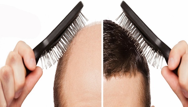 Is the Current Fad in Hair Transplantation Effective?