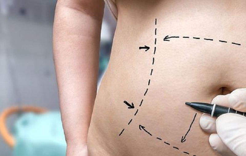 What You Should Know About A Tummy Tuck