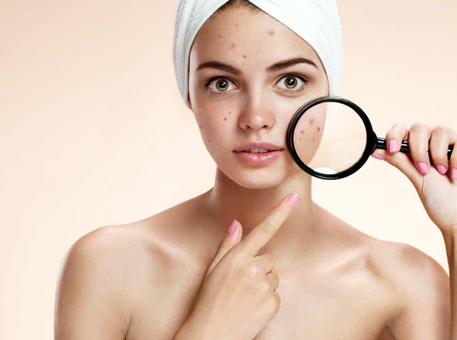What are Acne Scars and how are they treated?   