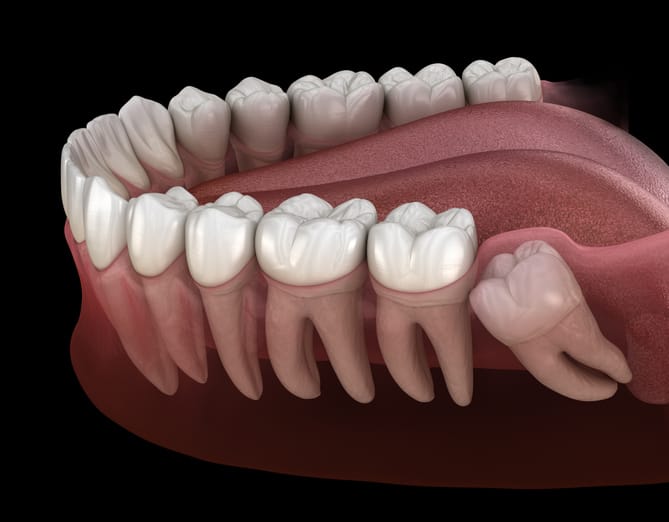 Tips to consider before wisdom tooth removal 