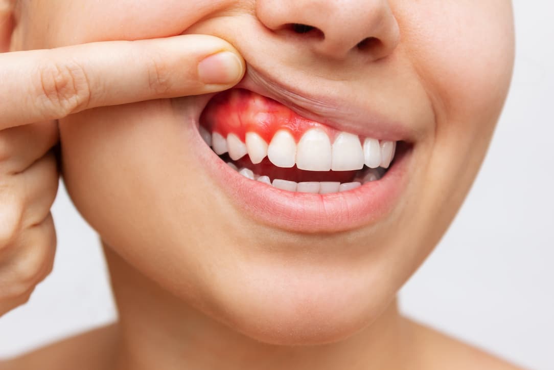 When Should You Be Concerned About Bleeding Gums